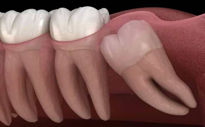 Wisdom Tooth removal in whitefield