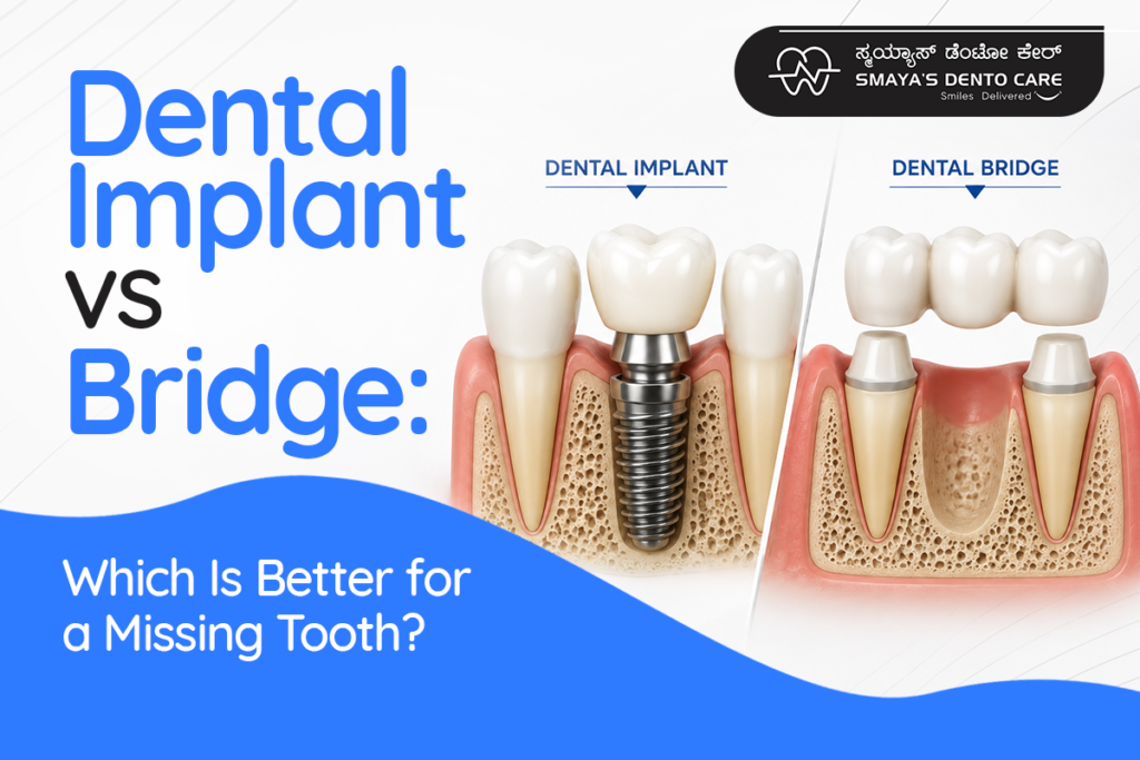 Dental Implant vs Bridge