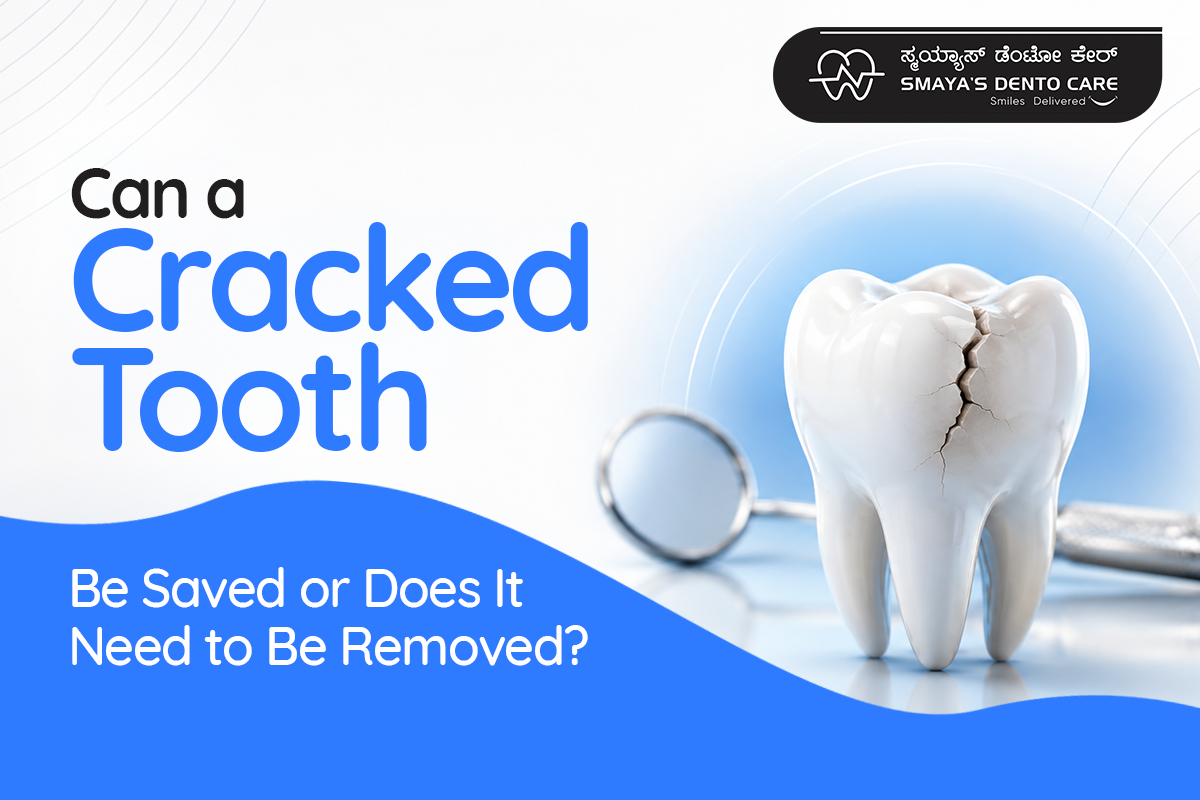 cracked tooth treatment in bangalore