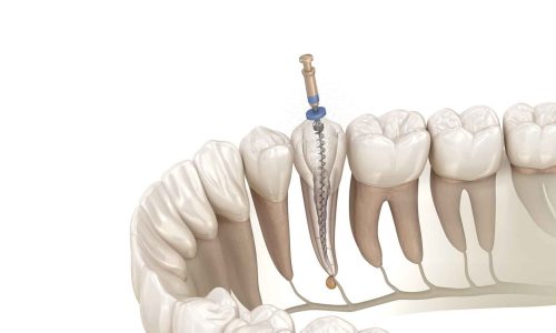 Root Canal